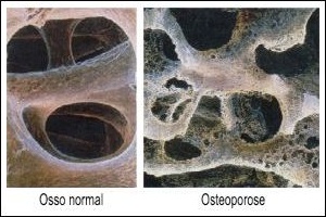 Osteoporose